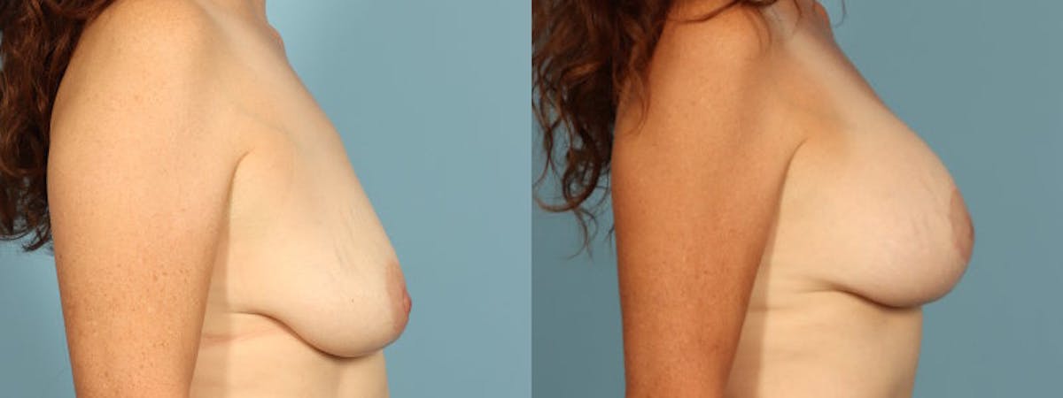 Breast Augmentation w/ Lift Before & After Gallery - Patient 186243 - Image 5