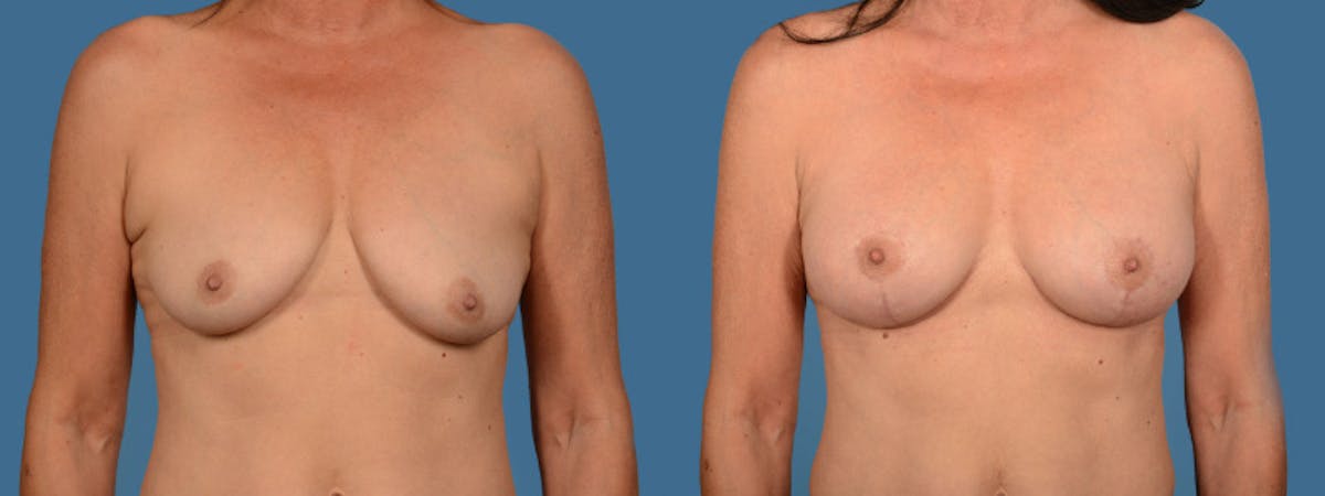 Breast Augmentation w/ Lift Before & After Gallery - Patient 104305 - Image 1