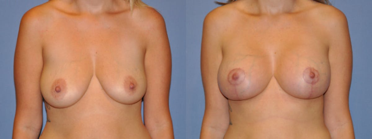Breast Augmentation w/ Lift Before & After Gallery - Patient 319217 - Image 1