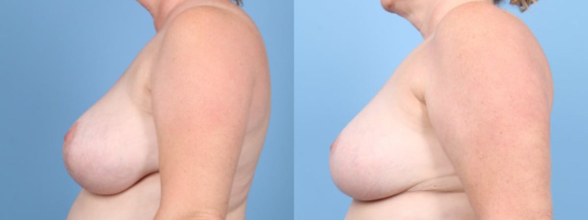 Breast Reduction/Lift Before & After Gallery - Patient 346932 - Image 5
