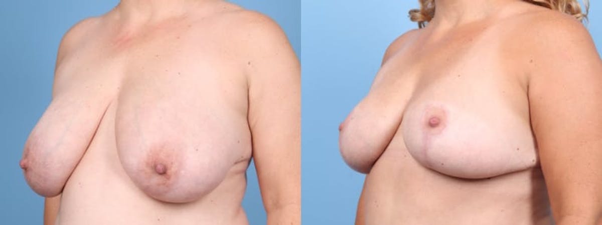 Breast Reduction/Lift Before & After Gallery - Patient 355895 - Image 2