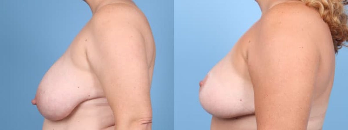Breast Reduction/Lift Before & After Gallery - Patient 355895 - Image 5