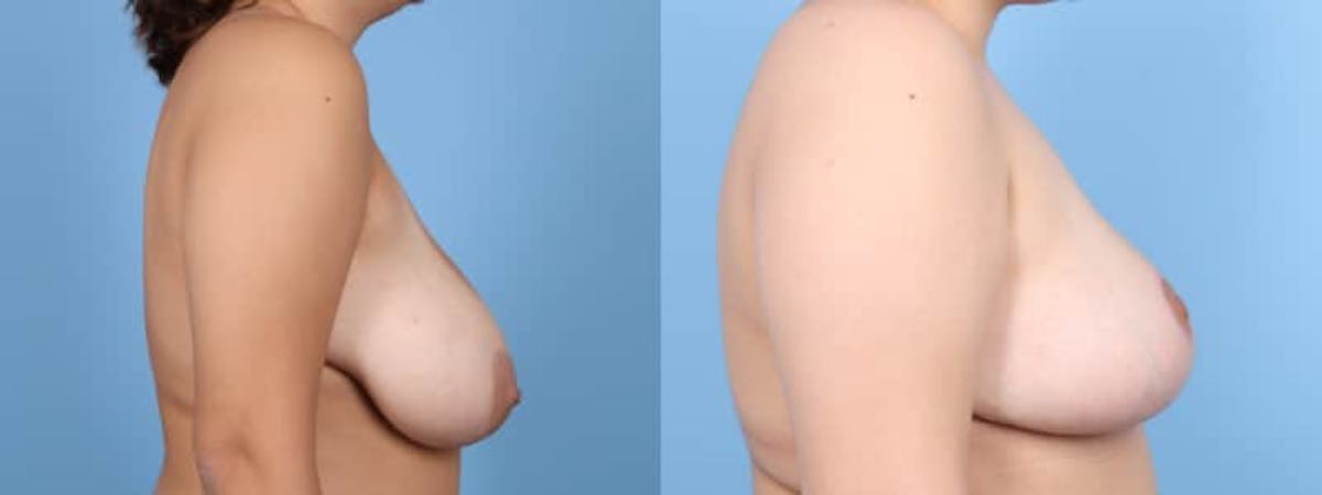 Breast Reduction/Lift Before & After Gallery - Patient 125598 - Image 4