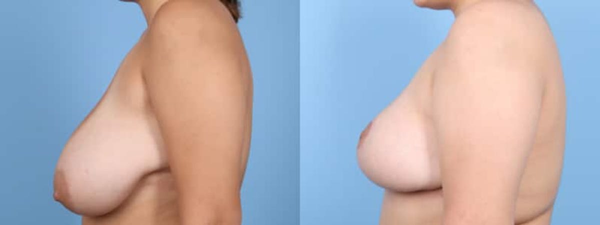 Breast Reduction/Lift Before & After Gallery - Patient 125598 - Image 5