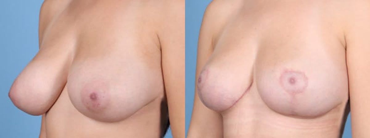 Breast Reduction/Lift Before & After Gallery - Patient 287616 - Image 3