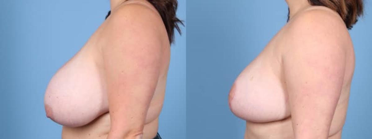 Breast Reduction/Lift Before & After Gallery - Patient 228499 - Image 4