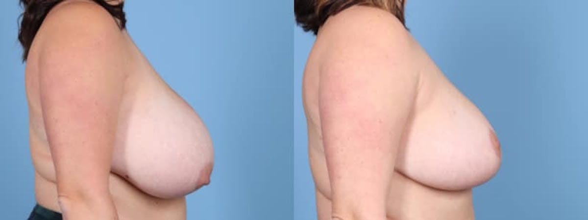 Breast Reduction/Lift Before & After Gallery - Patient 228499 - Image 5