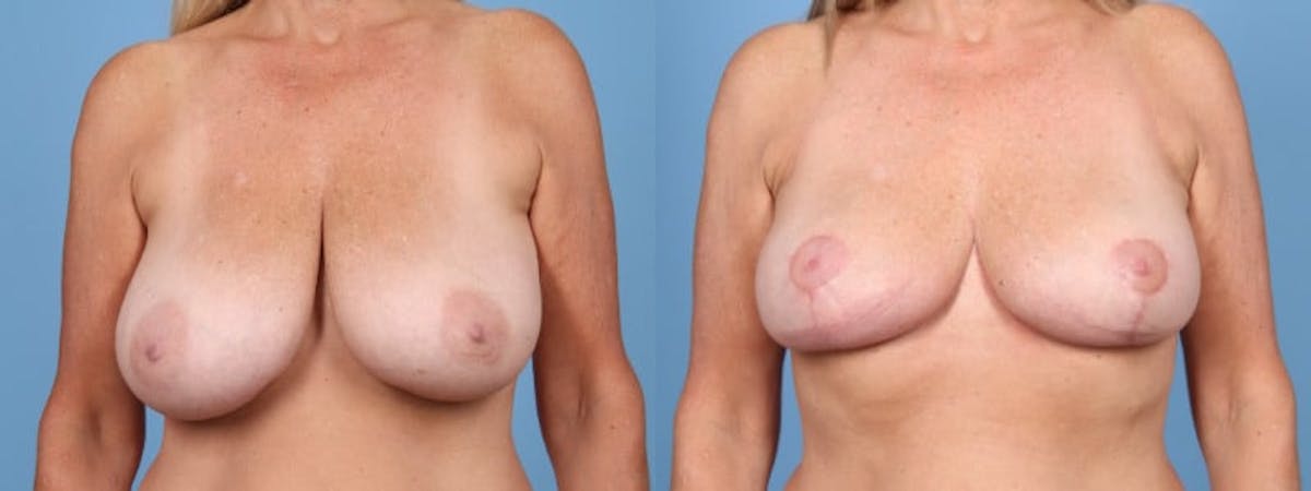 Breast Reduction/Lift Before & After Gallery - Patient 229672 - Image 1