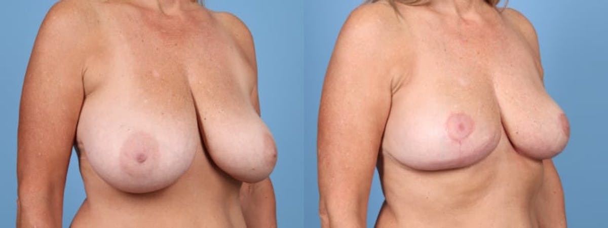 Breast Reduction/Lift Before & After Gallery - Patient 229672 - Image 2