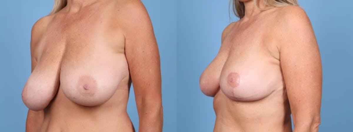 Breast Reduction/Lift Before & After Gallery - Patient 229672 - Image 3