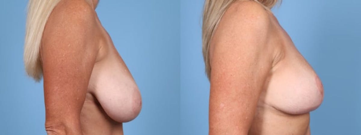 Breast Reduction/Lift Before & After Gallery - Patient 229672 - Image 5