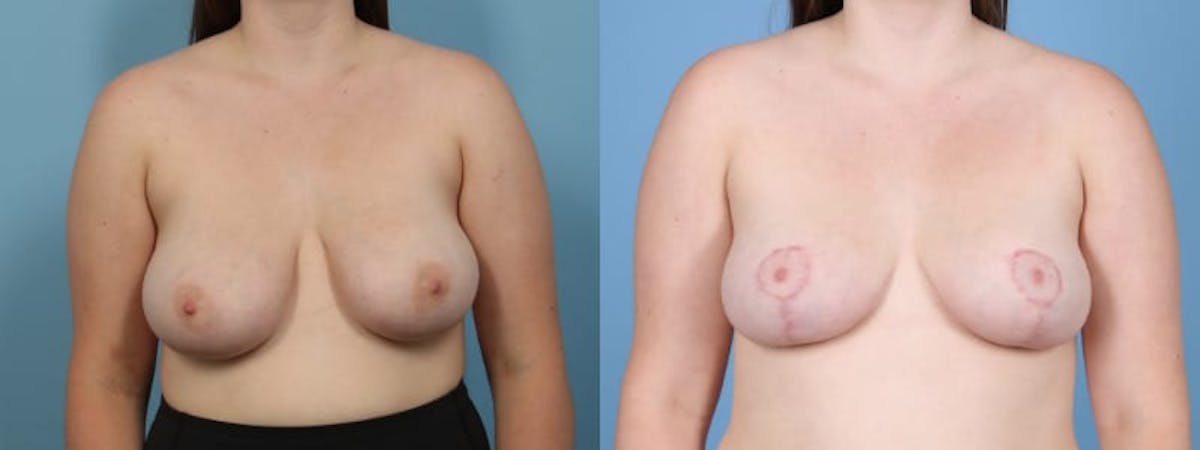 Breast Reduction/Lift Before & After Gallery - Patient 272843 - Image 1