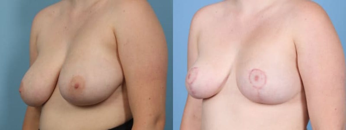 Breast Reduction/Lift Before & After Gallery - Patient 272843 - Image 2