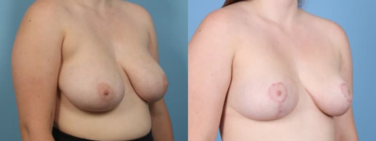Breast Reduction/Lift Before & After Gallery - Patient 272843 - Image 3