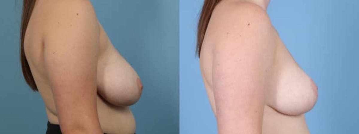 Breast Reduction/Lift Before & After Gallery - Patient 272843 - Image 4