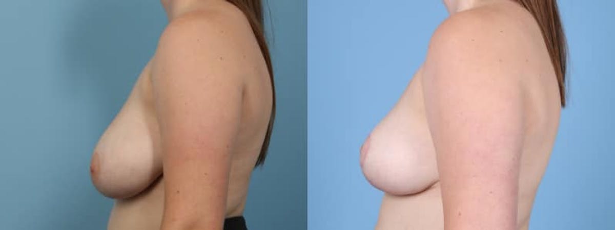 Breast Reduction/Lift Before & After Gallery - Patient 272843 - Image 5