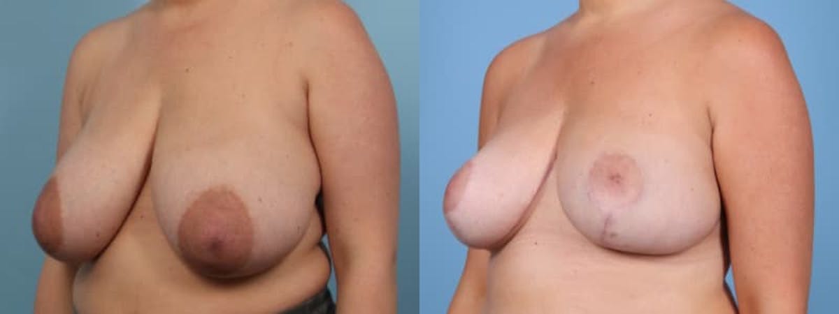 Breast Reduction/Lift Before & After Gallery - Patient 150852 - Image 2
