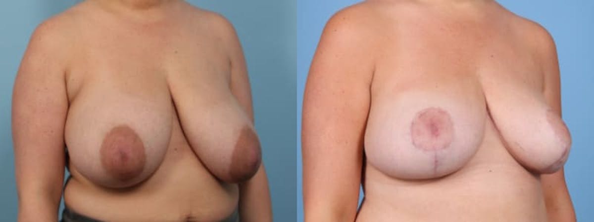 Breast Reduction/Lift Before & After Gallery - Patient 150852 - Image 3