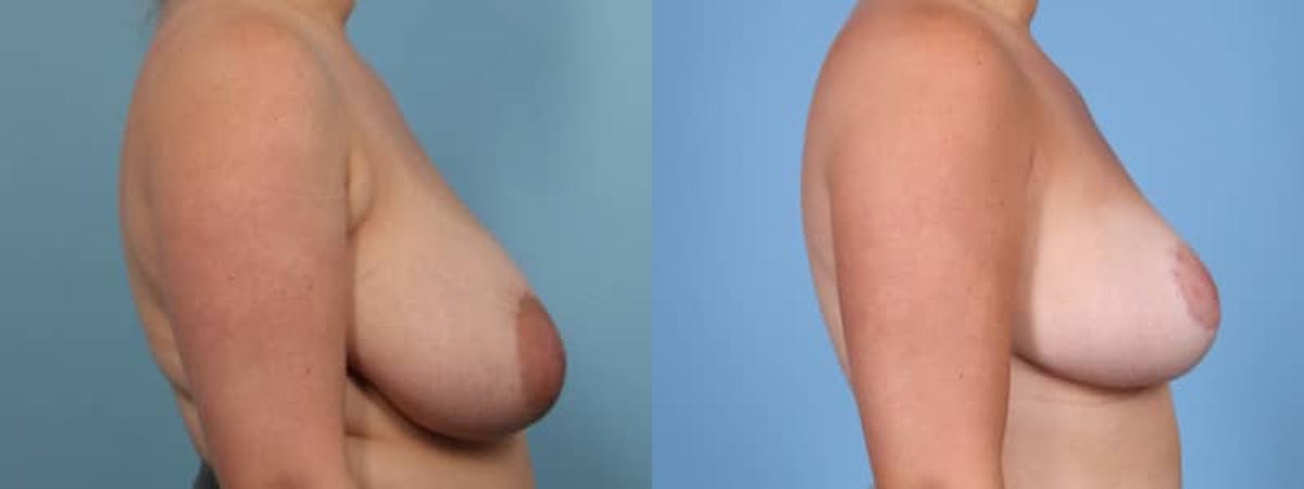 Breast Reduction/Lift Before & After Gallery - Patient 150852 - Image 4