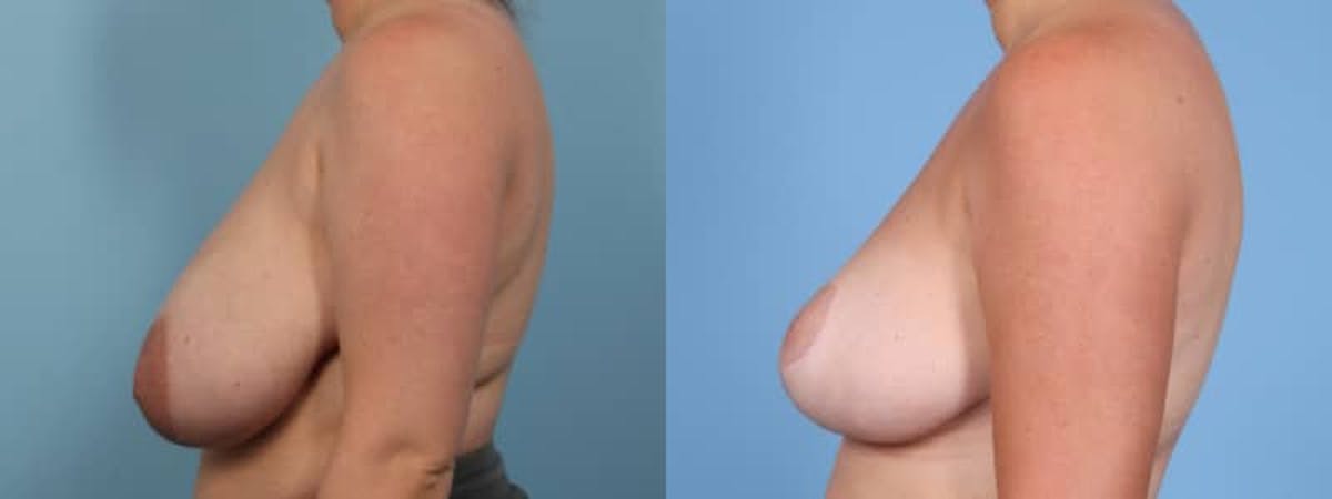 Breast Reduction/Lift Before & After Gallery - Patient 150852 - Image 5