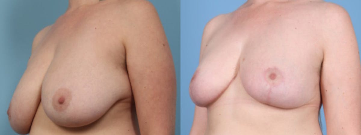 Breast Reduction/Lift Before & After Gallery - Patient 516610 - Image 2