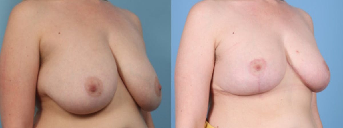 Breast Reduction/Lift Before & After Gallery - Patient 516610 - Image 3