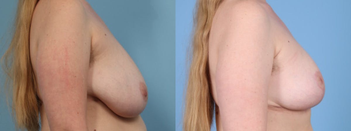 Breast Reduction/Lift Before & After Gallery - Patient 516610 - Image 4
