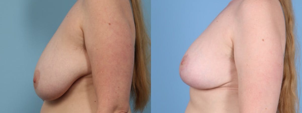 Breast Reduction/Lift Before & After Gallery - Patient 516610 - Image 5