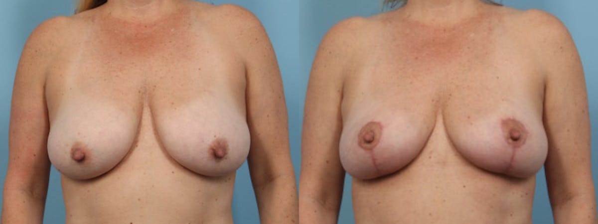 Breast Reduction/Lift Before & After Gallery - Patient 489342 - Image 1