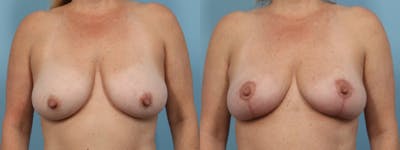 Breast Reduction/Lift Before & After Gallery - Patient 489342 - Image 1