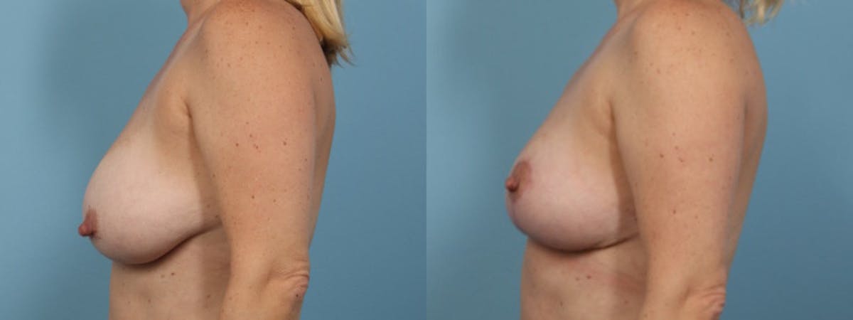 Breast Reduction/Lift Before & After Gallery - Patient 489342 - Image 4