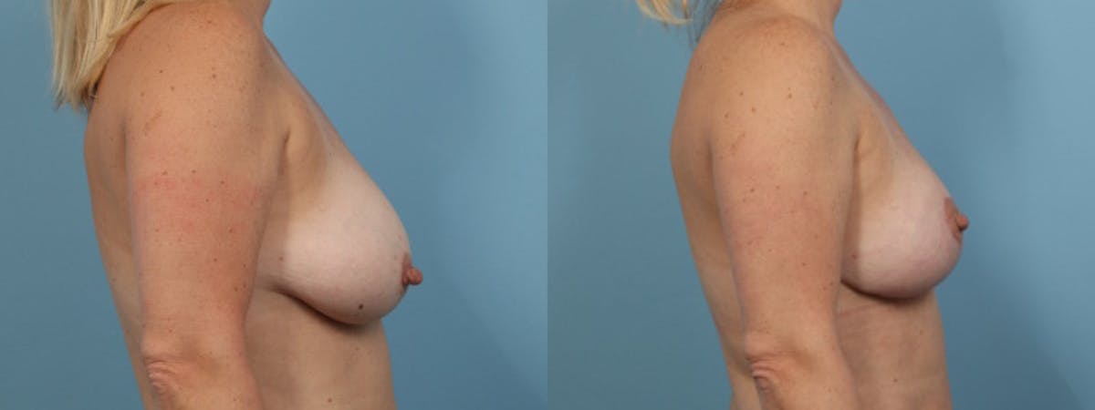 Breast Reduction/Lift Before & After Gallery - Patient 489342 - Image 5