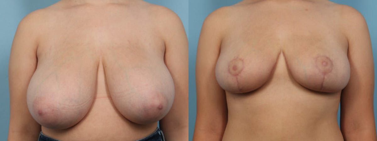 Breast Reduction/Lift Before & After Gallery - Patient 384877 - Image 1