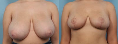 Breast Reduction/Lift Before & After Gallery - Patient 384877 - Image 1