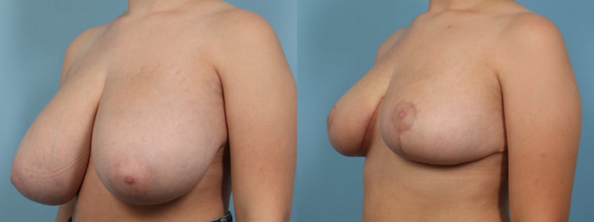 Breast Reduction/Lift Before & After Gallery - Patient 384877 - Image 3