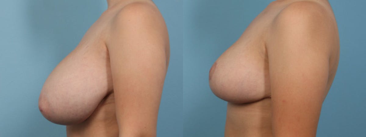 Breast Reduction/Lift Before & After Gallery - Patient 384877 - Image 4