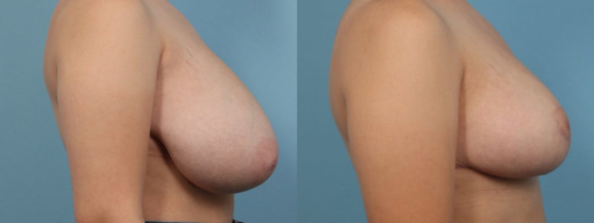 Breast Reduction/Lift Before & After Gallery - Patient 384877 - Image 5