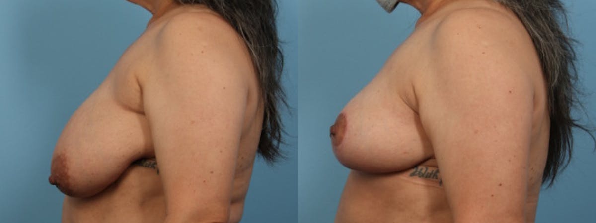 Breast Reduction/Lift Before & After Gallery - Patient 114628 - Image 4