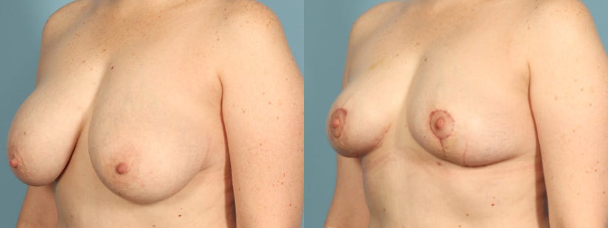 Breast Reduction/Lift Before & After Gallery - Patient 108627 - Image 2