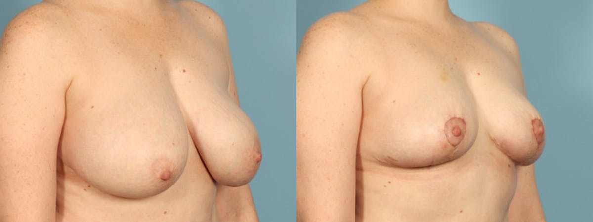 Breast Reduction/Lift Before & After Gallery - Patient 108627 - Image 3