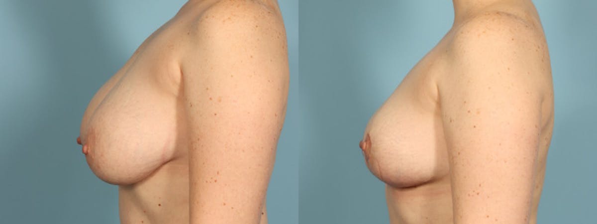 Breast Reduction/Lift Before & After Gallery - Patient 108627 - Image 4