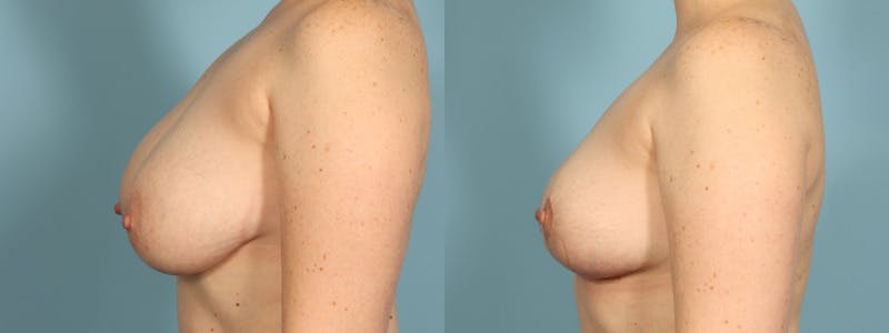 Breast Reduction/Lift Before & After Gallery - Patient 108627 - Image 4