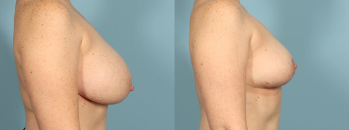 Breast Reduction/Lift Before & After Gallery - Patient 108627 - Image 5
