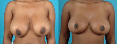 Breast Reduction/Lift Before & After Gallery - Patient 162573 - Image 1