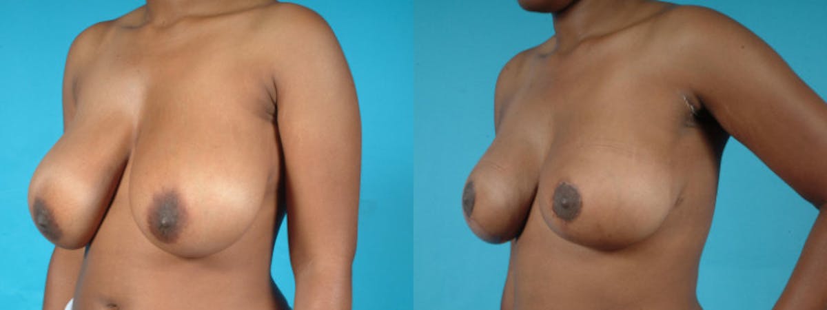 Breast Reduction/Lift Before & After Gallery - Patient 162573 - Image 3