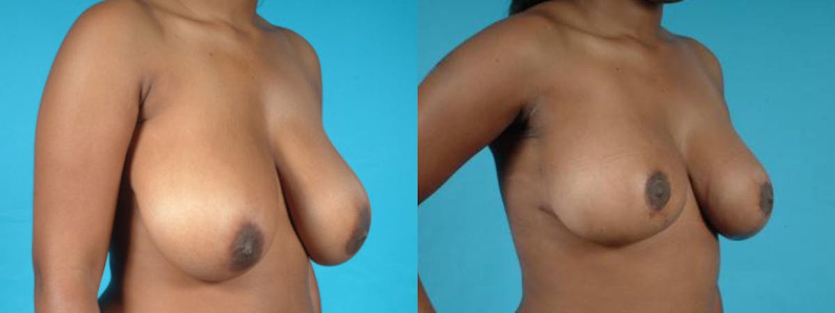 Breast Reduction/Lift Before & After Gallery - Patient 162573 - Image 4