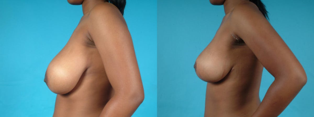 Breast Reduction/Lift Before & After Gallery - Patient 162573 - Image 5