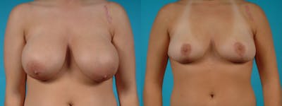 Breast Reduction/Lift Before & After Gallery - Patient 325536 - Image 1
