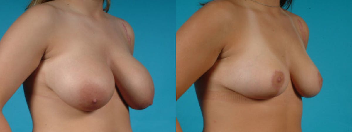 Breast Reduction/Lift Before & After Gallery - Patient 325536 - Image 3