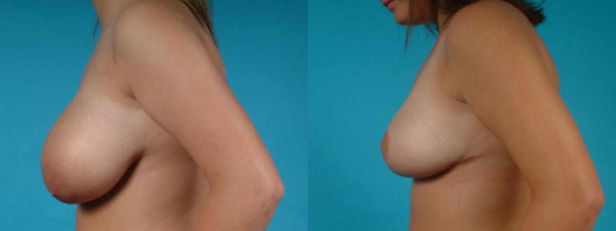Breast Reduction/Lift Before & After Gallery - Patient 325536 - Image 4